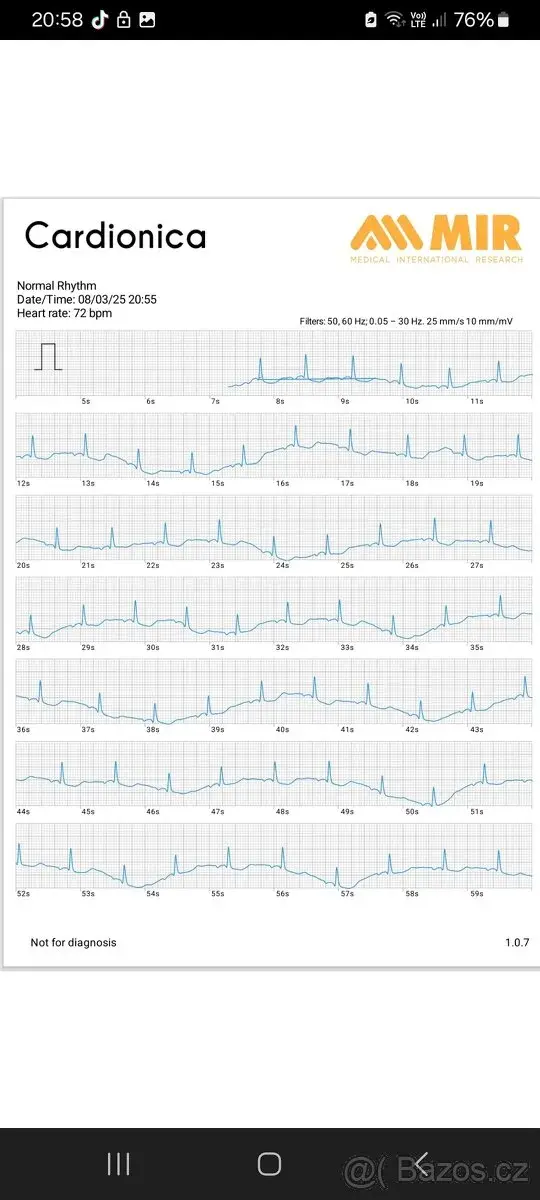 EKG Holter/epizodní záznamník
